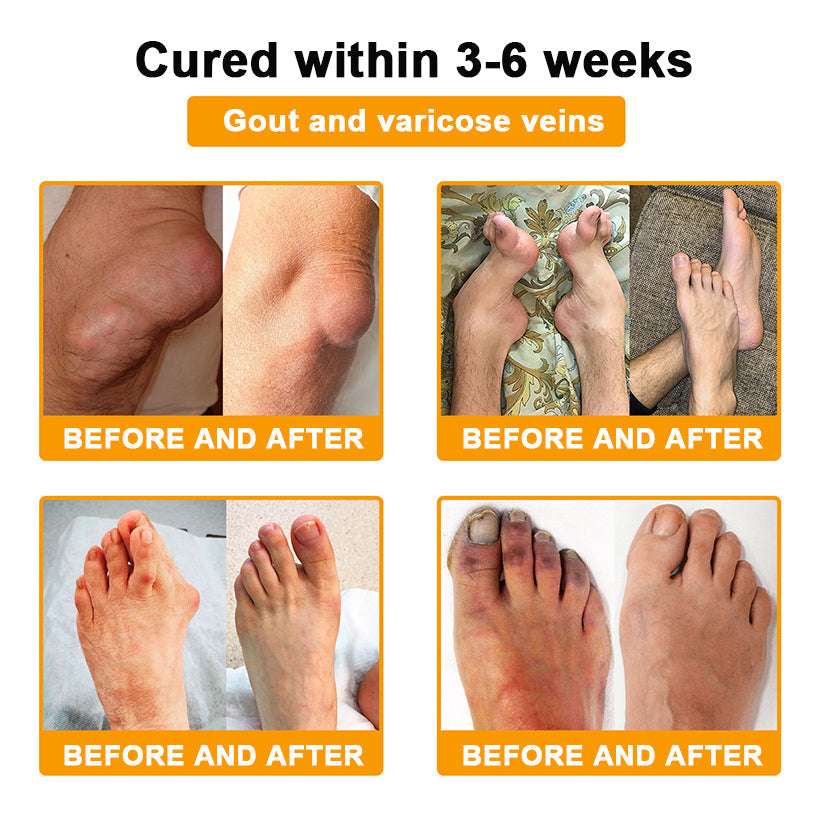 🎁Flash Sale - Natravor® Botulinum Toxin & Bee Venom Pain-Relief Bone Healing Cream🐝💎