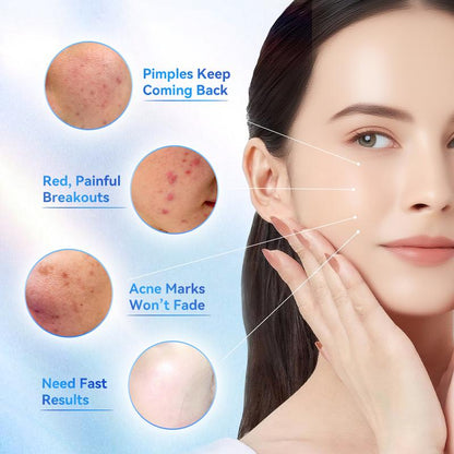 Salicylic Acid Acne Treatment Drying Lotion